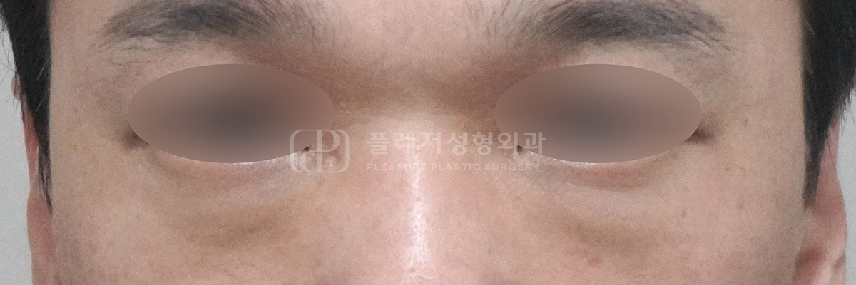지방 돌출형 다크서클