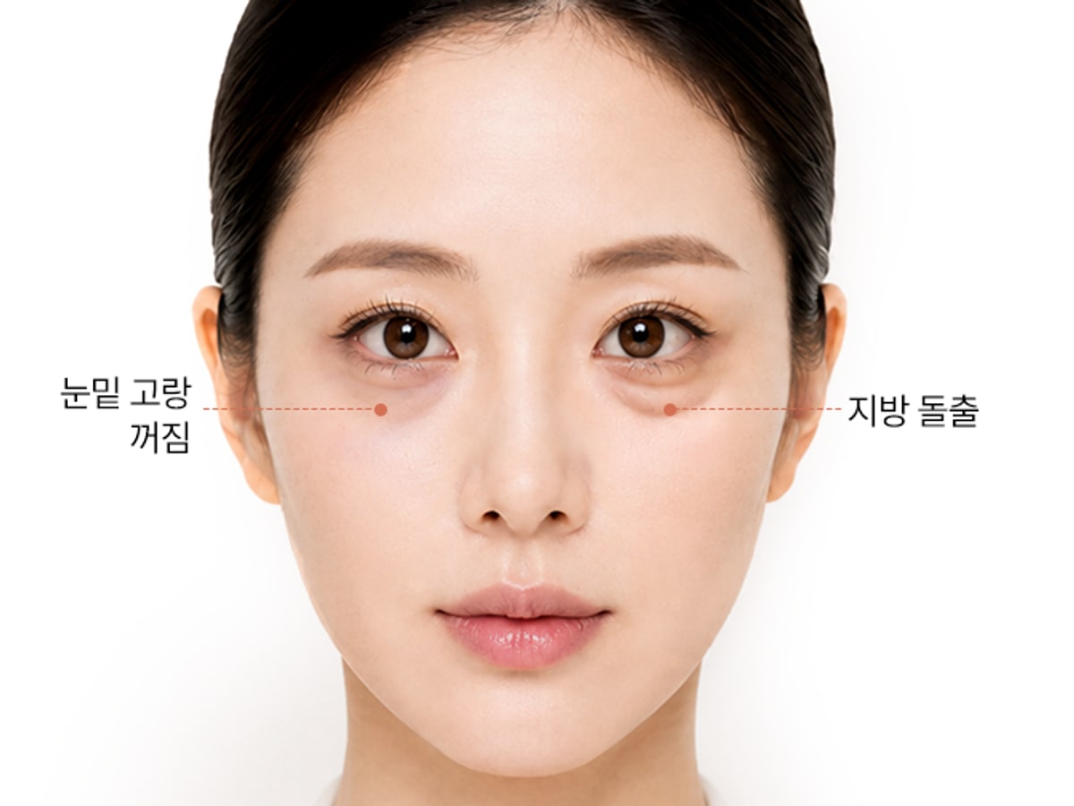 눈밑 지방 돌출과 눈물고랑 꺼짐 위치를 표시한 눈밑