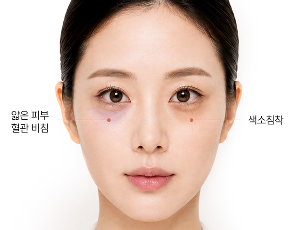 얇은 피부로 인한 혈관 비침과 색소침착 위치를 표시한 눈밑