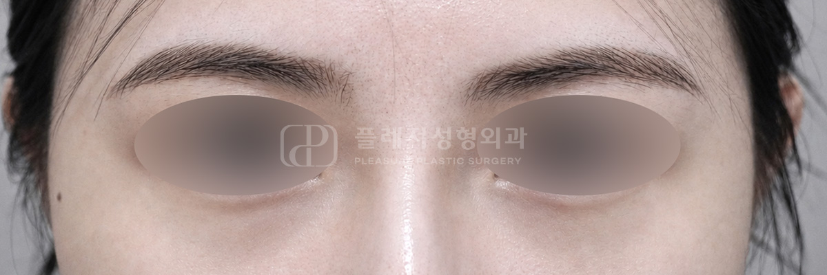 복합형 다크서클 수술 후 (케어 전)