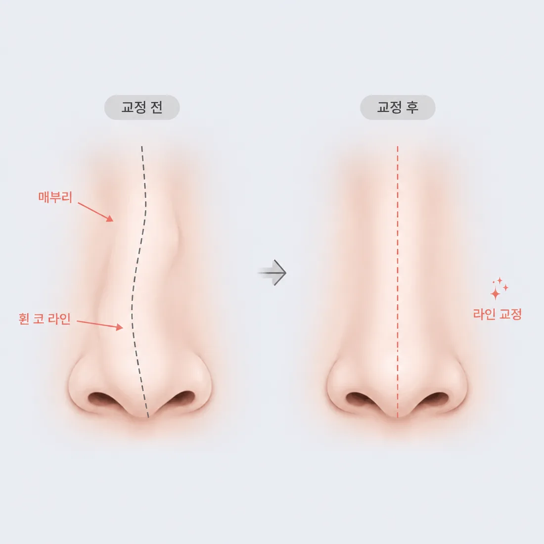 비개방 코성형 케이스4