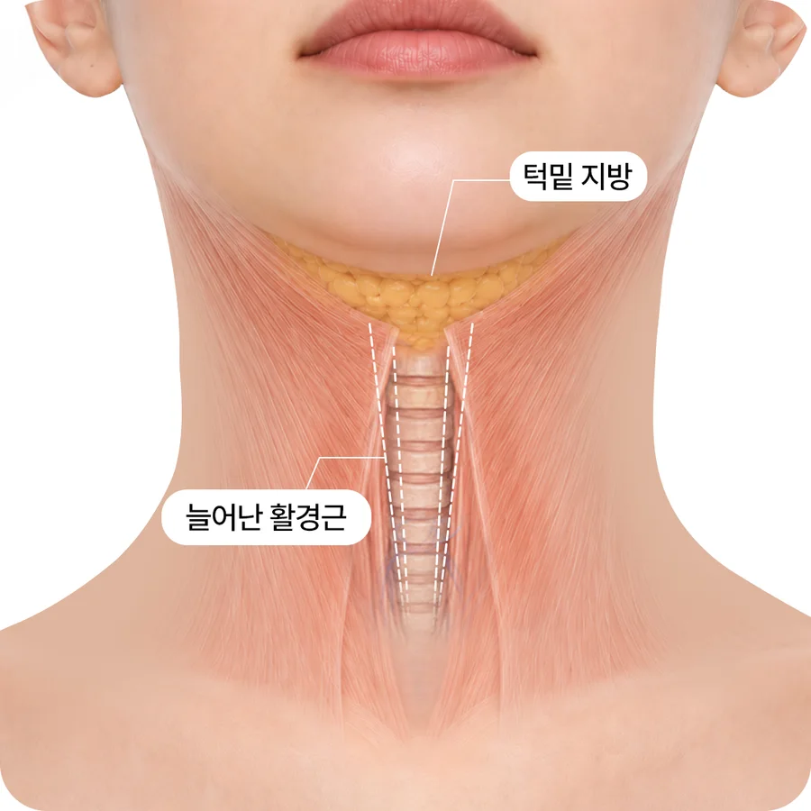 목·활경근 해부 일러스트 — 늘어진 이중턱 근육