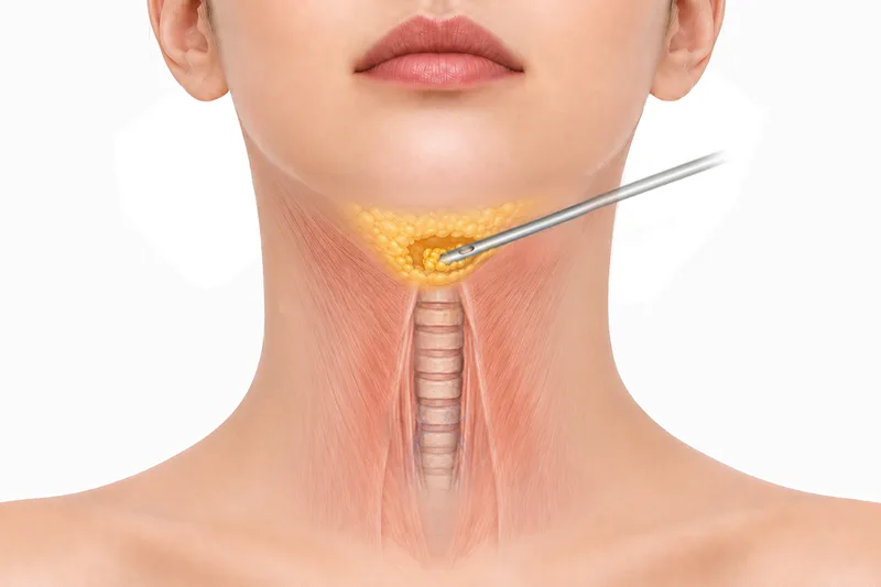 이중턱 지방흡입·근육묶기 순수지방 흡입