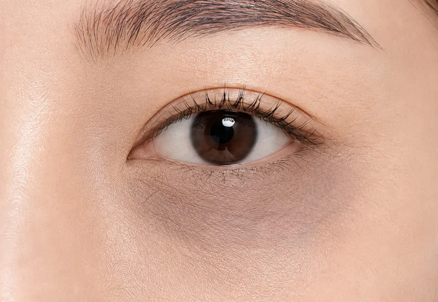 Visible blood vessels and dark circles in the eye area