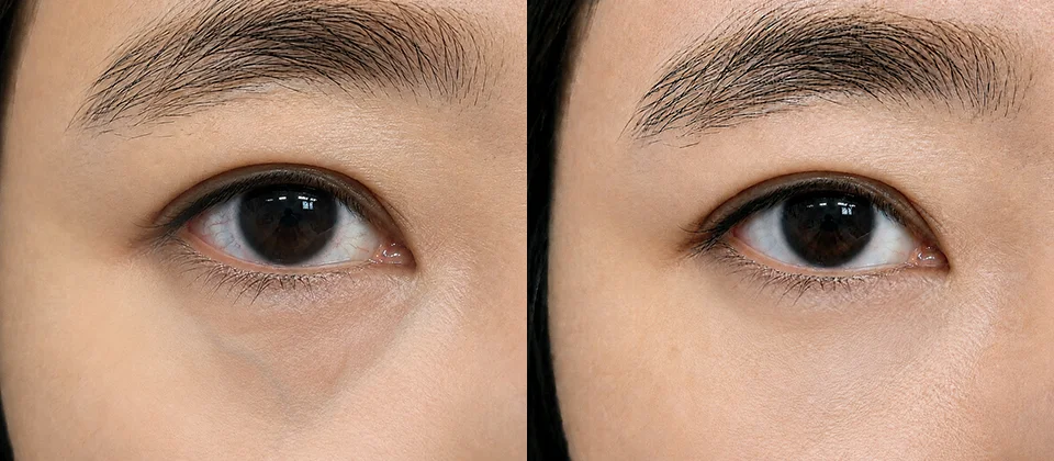 Thinness Skin Booster before & after photo