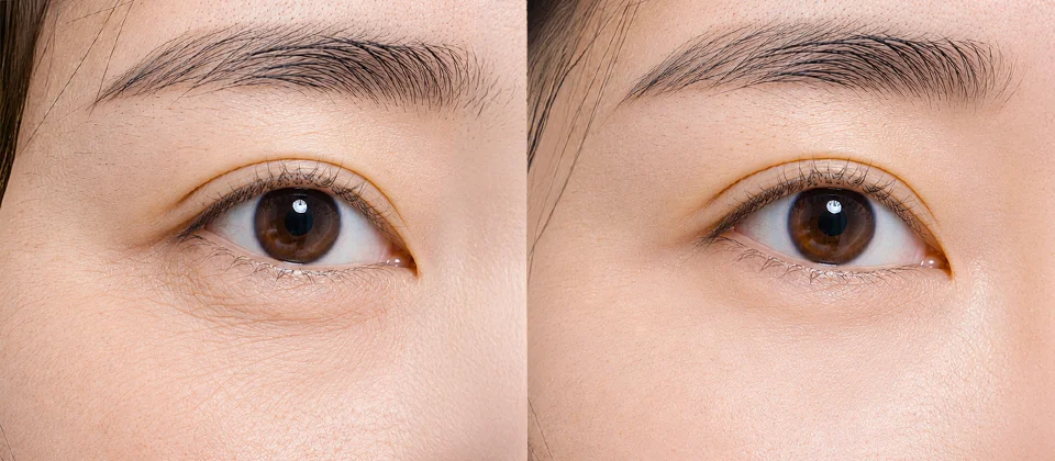 Fine Lines Skin Botox before & after photo