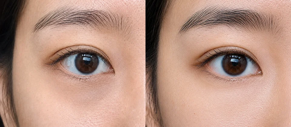 Dark Circles EBD before & after photo