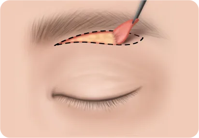 눈썹하거상 2