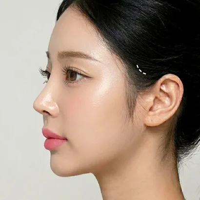 포니테일 리프팅 과정 1단계 — 헤어라인 안쪽 히든 절개 설계