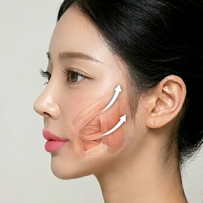 포니테일 리프팅 과정 3단계 — 내시경으로 중안면 SMAS층 박리