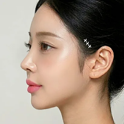 포니테일 리프팅 과정 4단계 — 사선 방향 고정 후 봉합