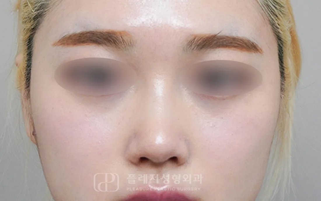 유형별 코성형 10