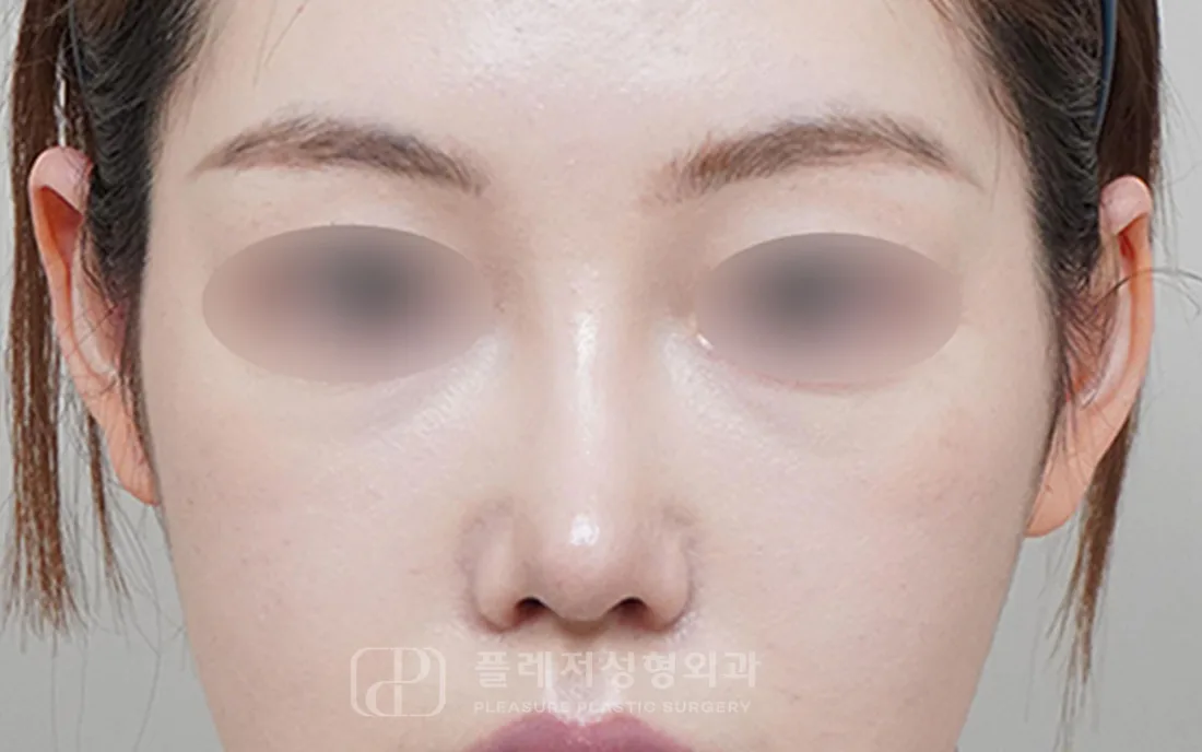유형별 코성형 휜코