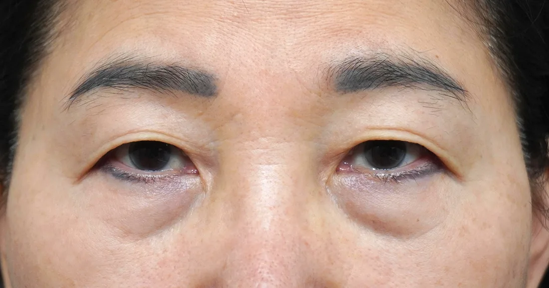 상안검 1