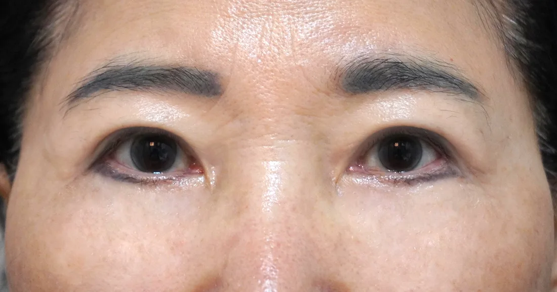 상안검 2