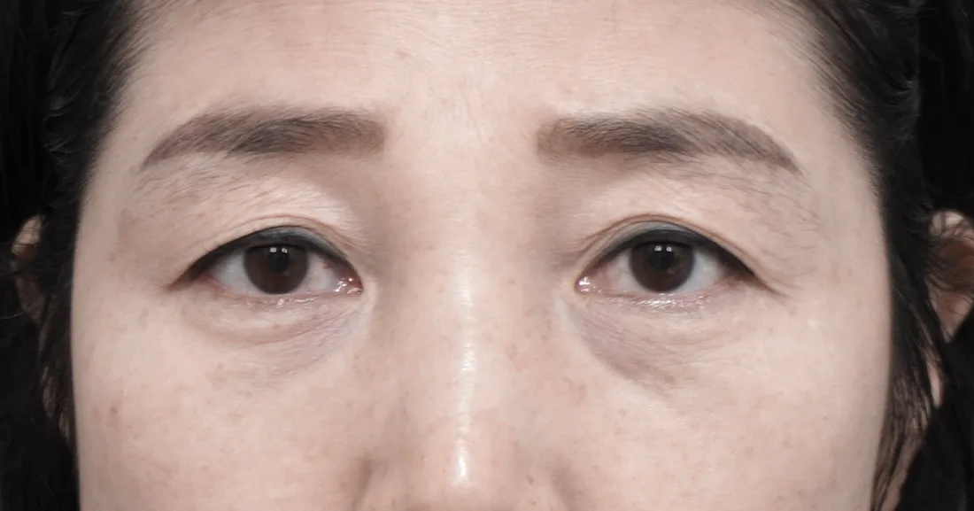 상안검 3
