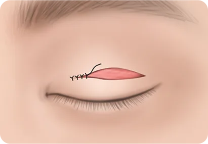 상안검 과정