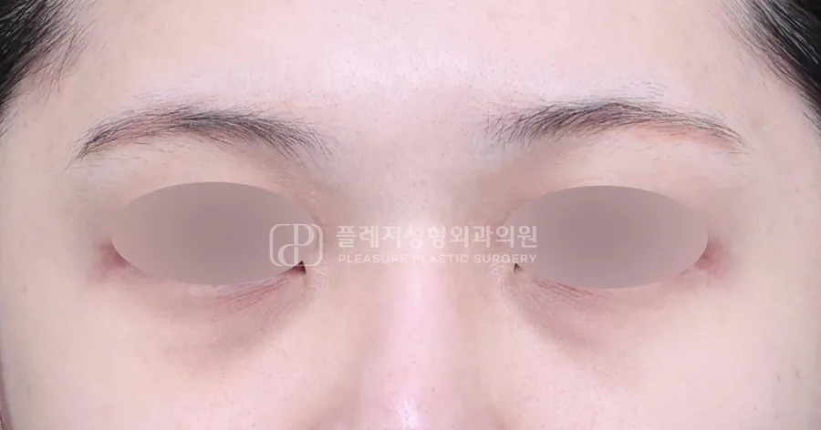 눈밑지방이식 전후