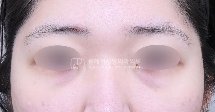 눈밑지방이식 전후