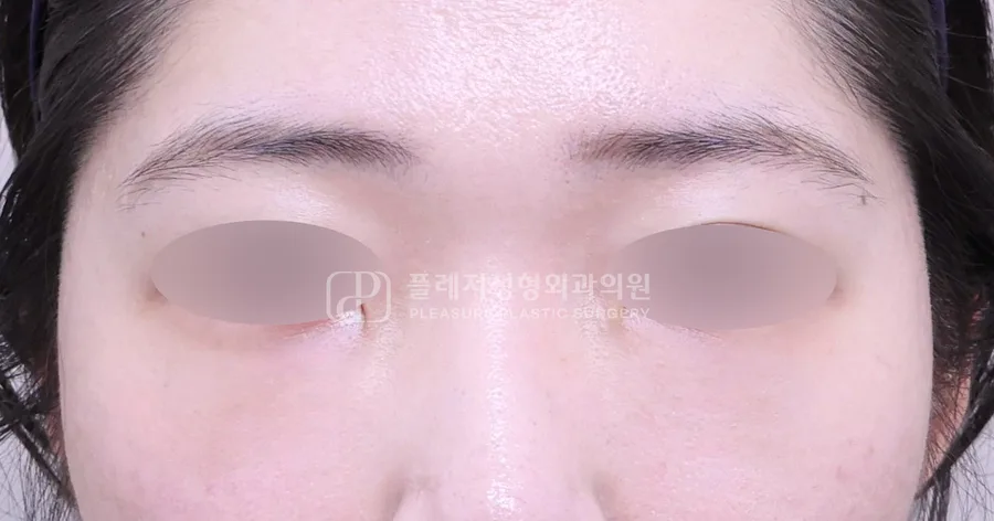 눈밑지방이식 전후