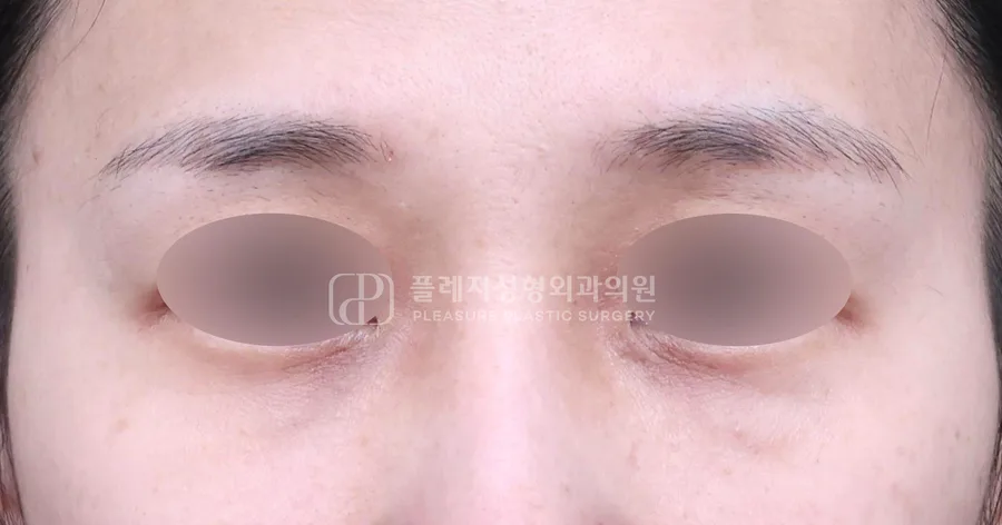눈밑지방이식 전후