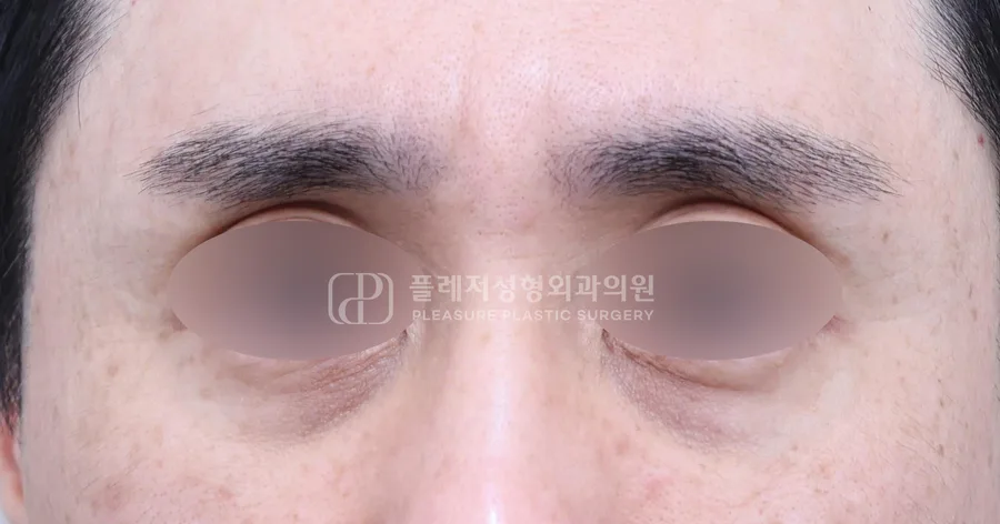 눈밑지방이식 전후
