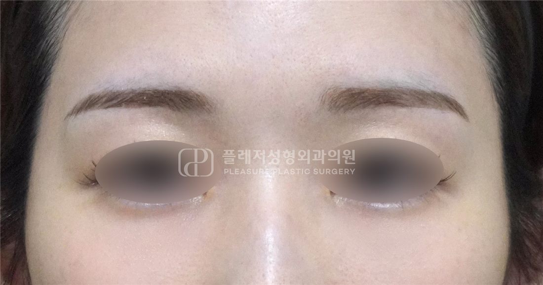 Case 05 After