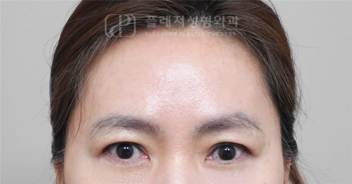눈썹 처짐 AFTER