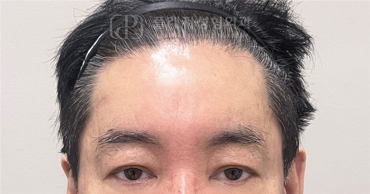 이마 주름 AFTER