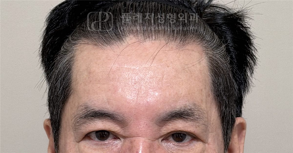 이마 주름 BEFORE